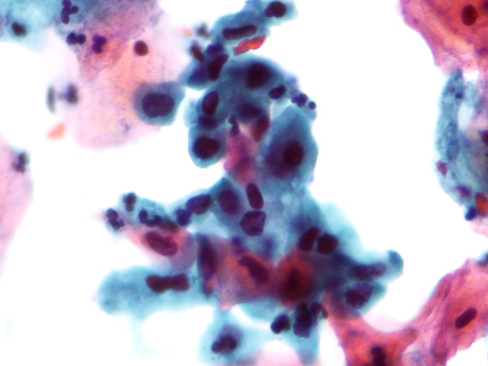Atipia de células escamosas no descartable HSIL (ASC-H) (9439523243)