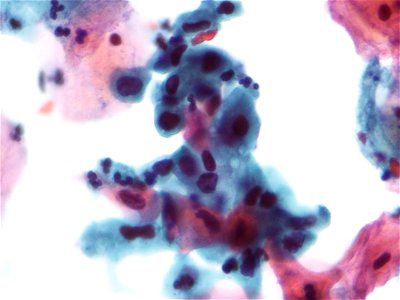 Atipia de células escamosas no descartable HSIL (ASC-H) (9439523243)