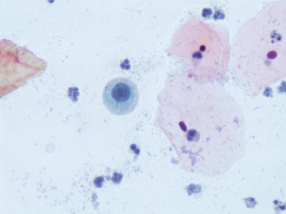 Atipia de ´células escamosas (ASC, ASCUS) (9292923873)