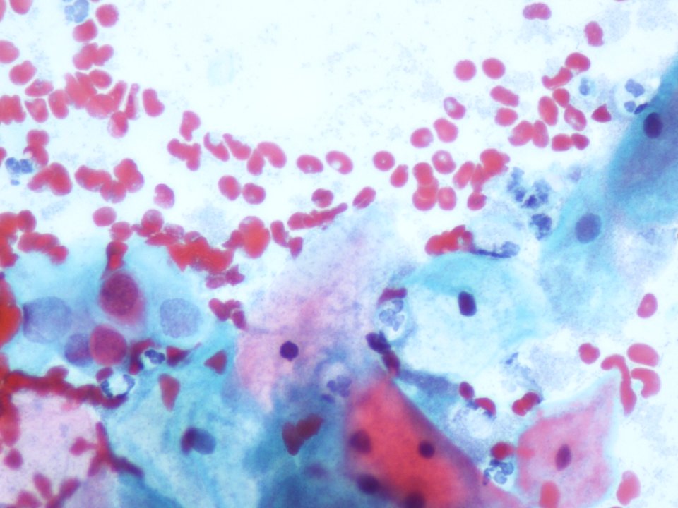 Atipia de células escamosas, probable LSIL, con vaginosis. (9132501506)