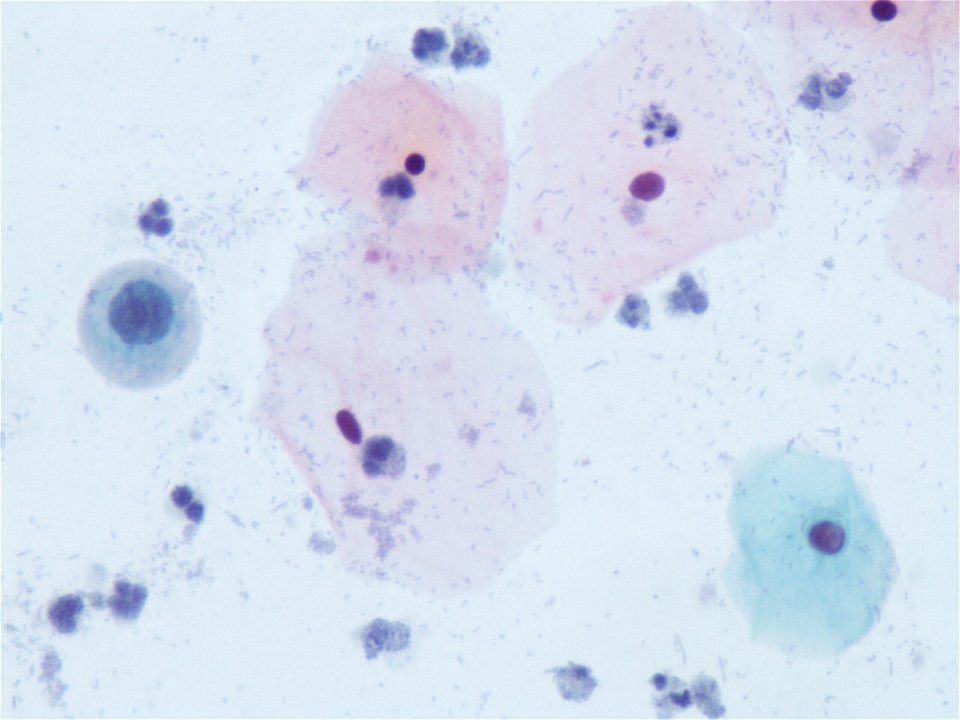 Atipia de ´células escamosas (ASC, ASCUS) (9295702360)