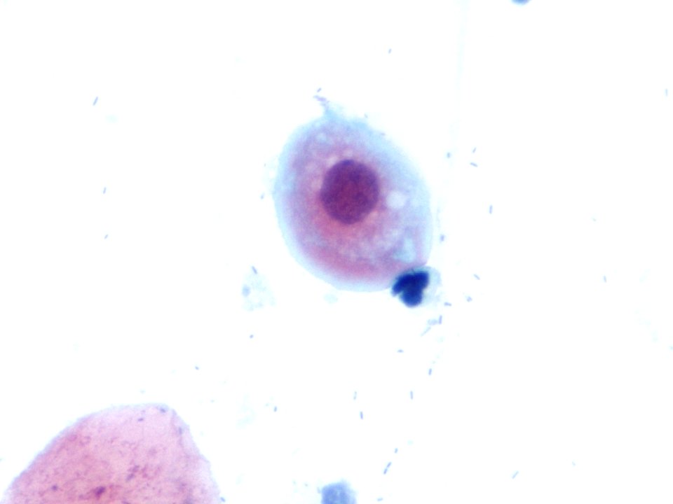 Atipia de células escamosas (ASCUS, ASC) (9392112125)