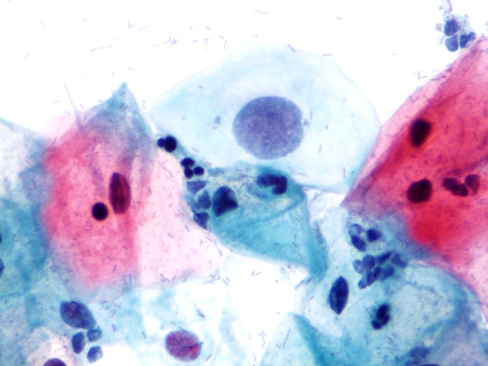 Atipia de células escamosas (ASCUS, ASC) (9394882140)