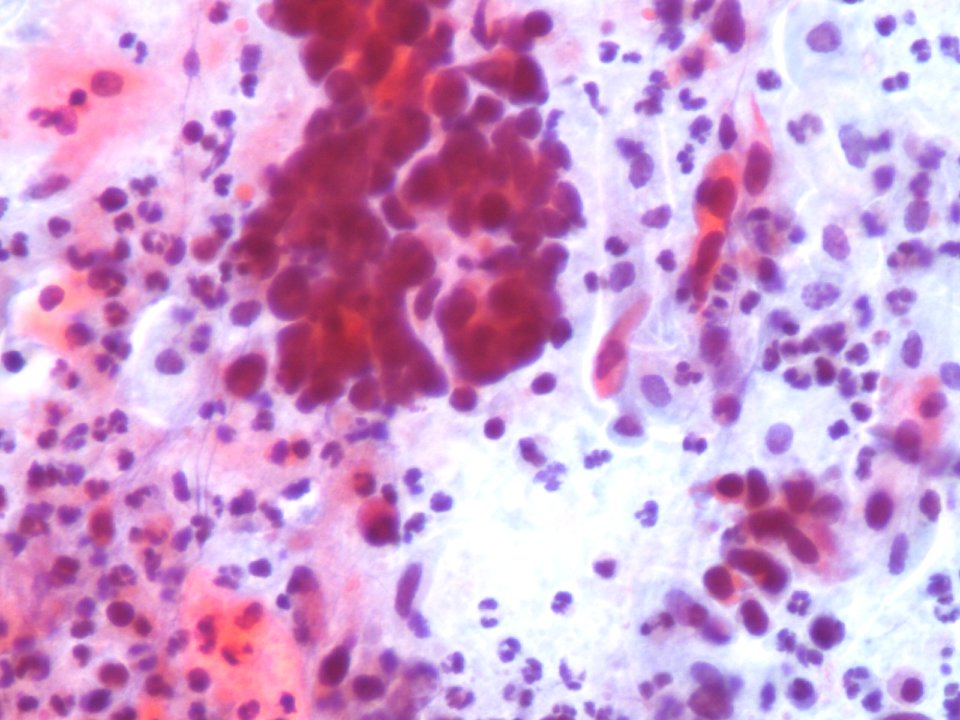 Carcinoma de células escamosas de cuello uterino (9789282116)