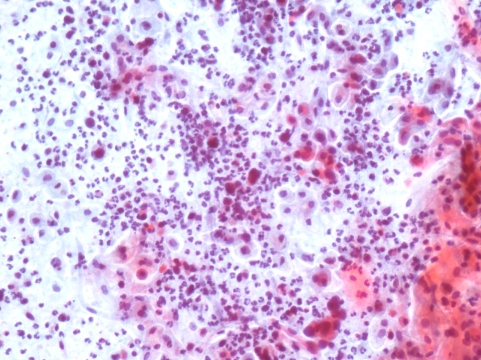 Carcinoma de células escamosas de cuello uterino (9789282146)