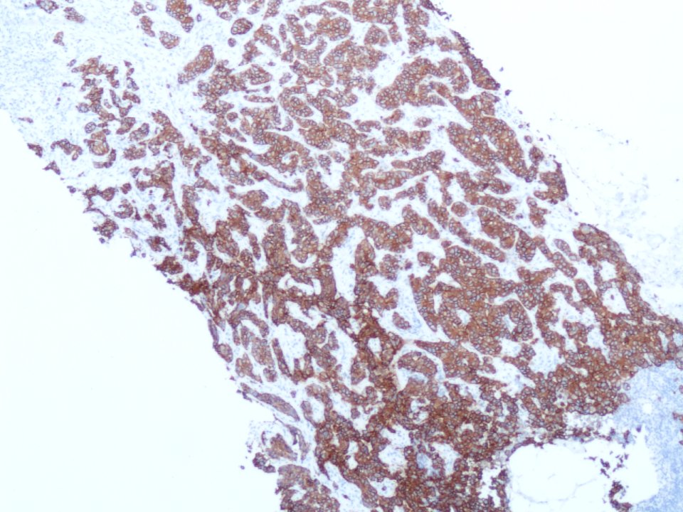 Carcinoma ductal infiltrante (Her-2) (9298095731)