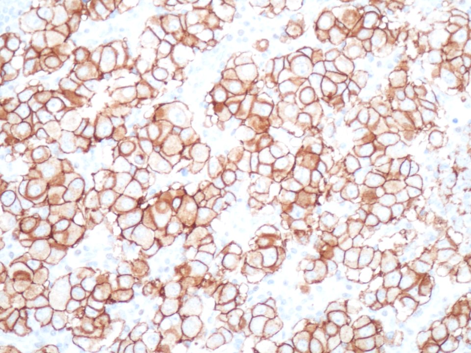 Carcinoma ductal infiltrante (Her-2) (9298296797)