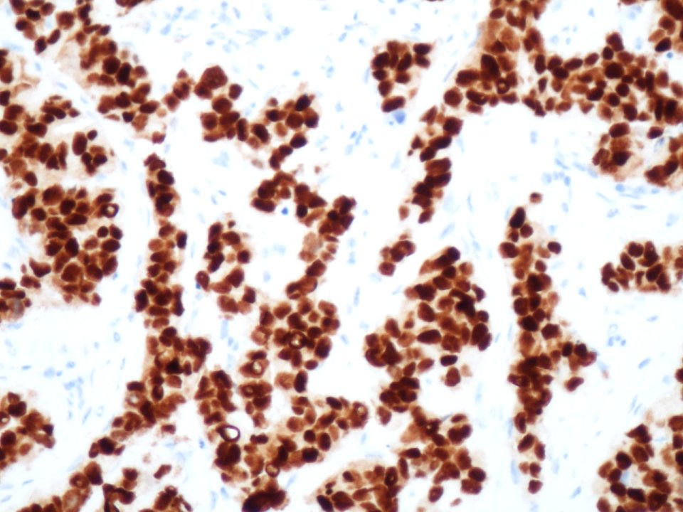 Carcinoma ductal infiltrante (receptores de estrógenos) (9300908084)