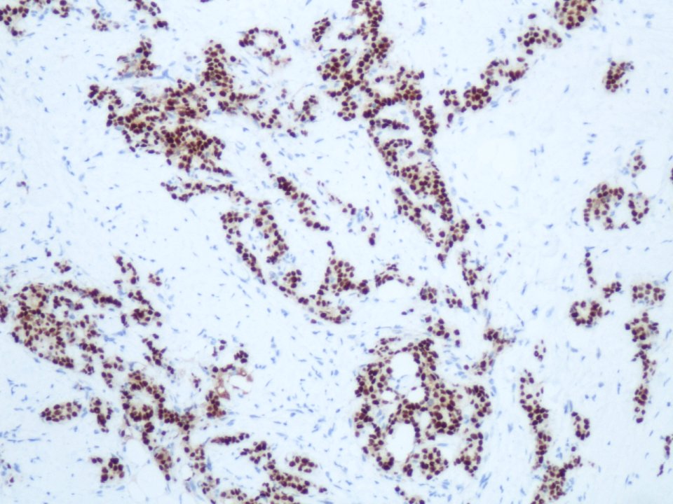 Carcinoma ductal infiltrante (receptores de progesterona) (9298962147)