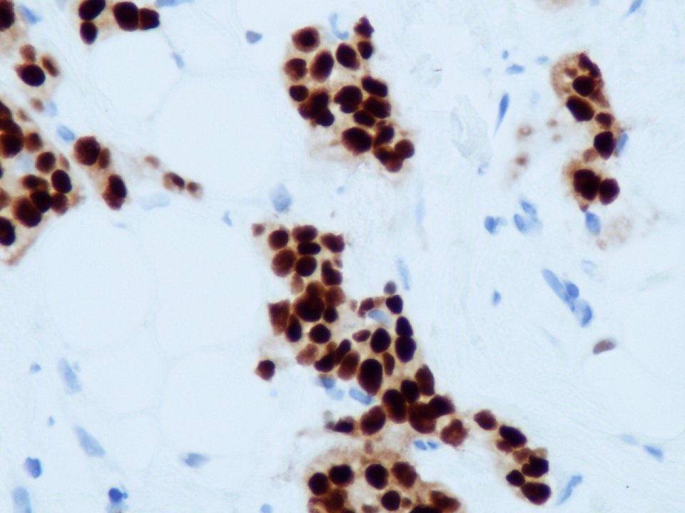 Carcinoma ductal infiltrante (receptores de estrógenos) (9301763058)