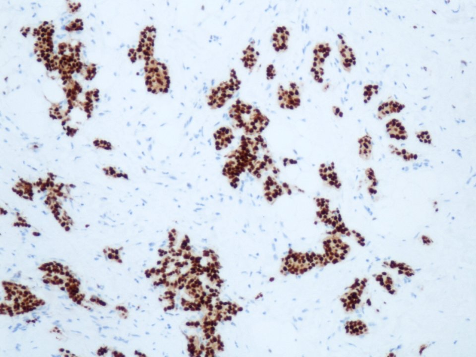 Carcinoma ductal infiltrante (receptores de estrógenos) (9301763038)