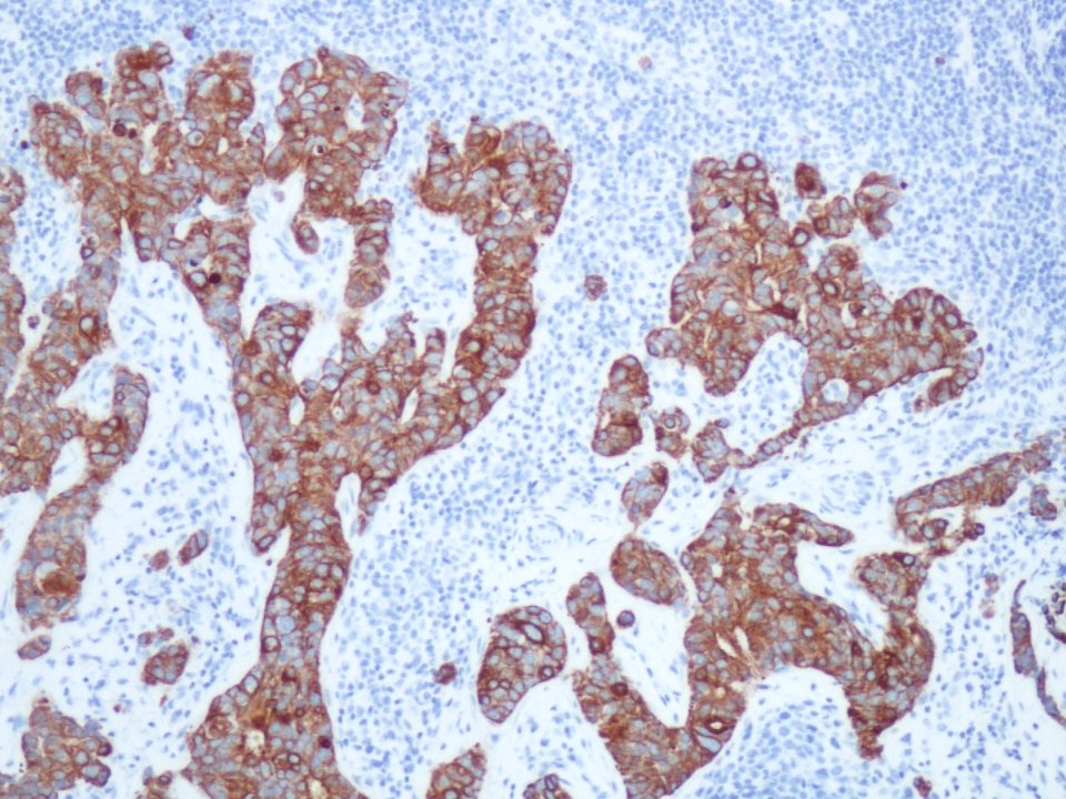 Carcinoma de mama metastásico (citoqueratina 19) (9298074369)