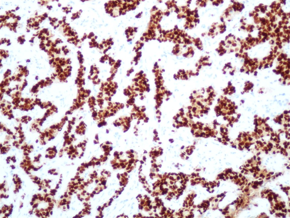 Carcinoma ductal infiltrante (receptores de estrógenos) (9298124855)