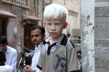Albinism skin boy