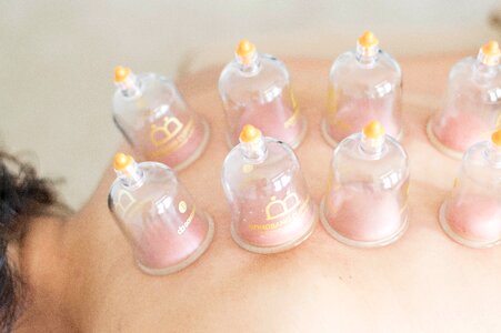 Alternative treatment cupping photo