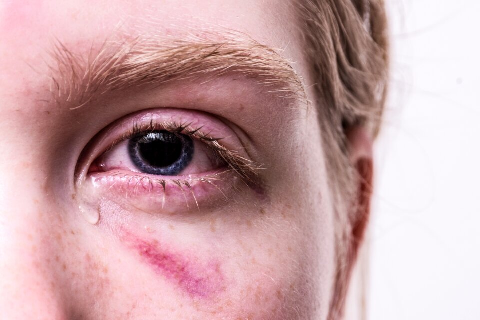 Tear traumatized pain