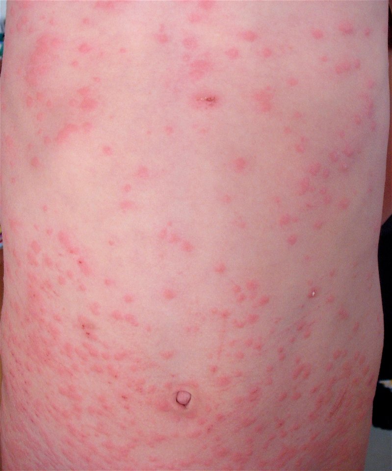 Oak processionary caterpillar rash
