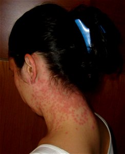Rash caused by searching something in a Prunus sp. bush infested with Euproctis Chrysorrhoea catterpillars (larvae) in different stages (mostly the last one) photo