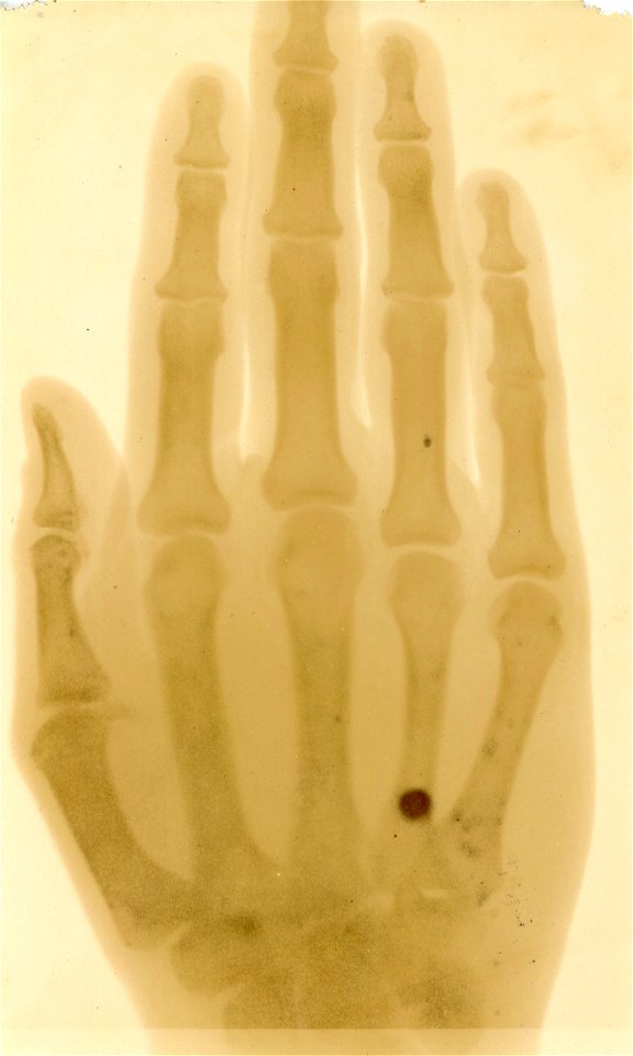 X-Ray Roentgenogram Image