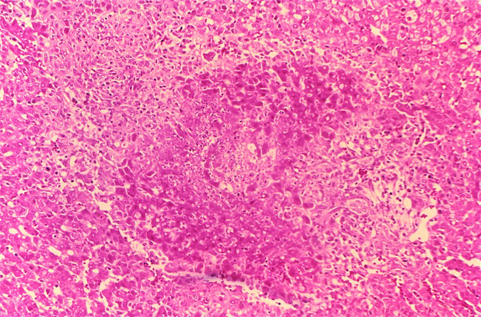Brucella granuloma