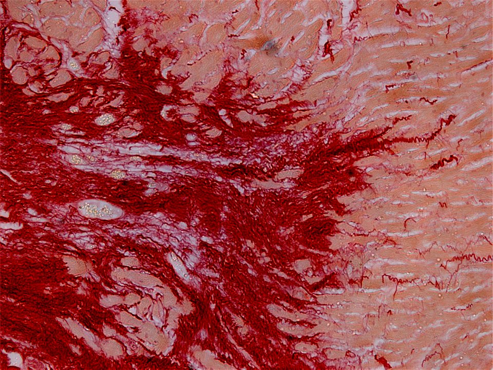 Myocardial infarction scar in the heart of a rat