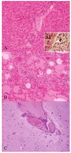 Lesions of Weissella confusa in the mona monkey (hematoxylin and eosin stain): A) liver: portal triads with neutrophilic infiltration (x10); A1, presence of bacterial emboli inside the vein (arrow) (x