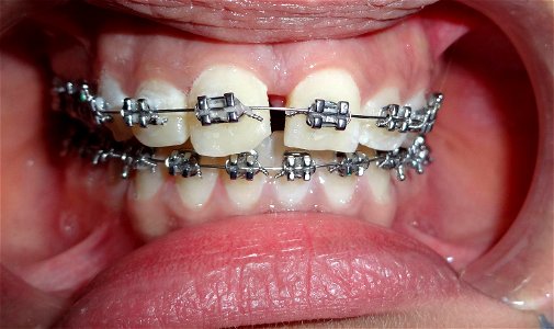 Dental Braces photo