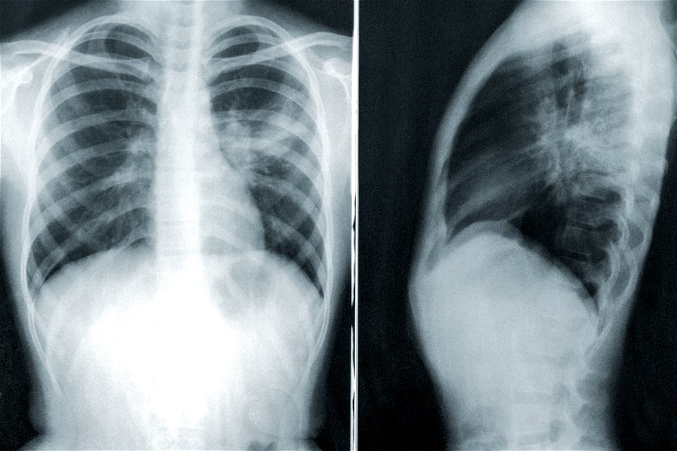 X Ray Pneumonia