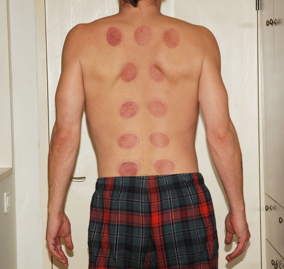 Acupuncture marks chinese