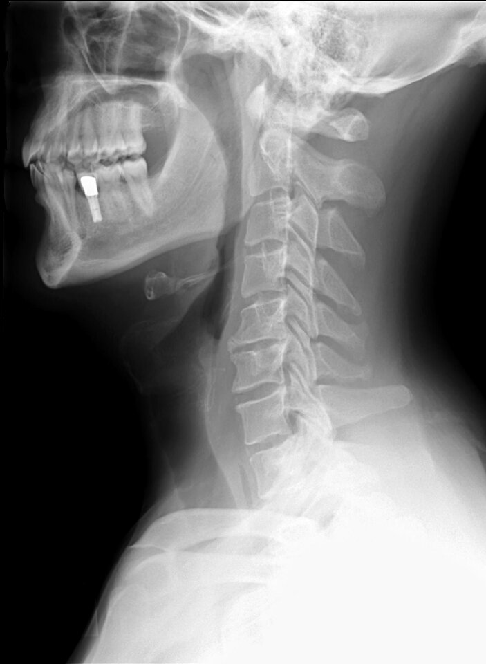 X ray neck bone