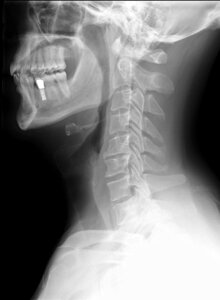 X ray neck bone photo
