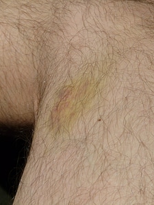 Discoloration green yellow