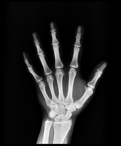 Hand bone x ray
