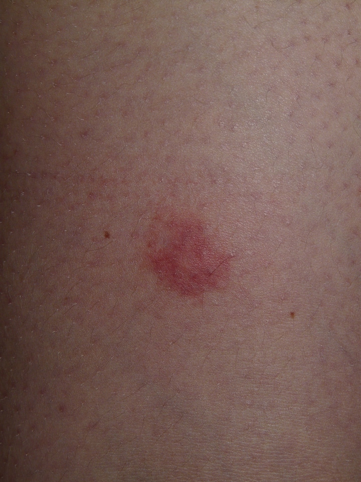 Injection site allergic reaction warty