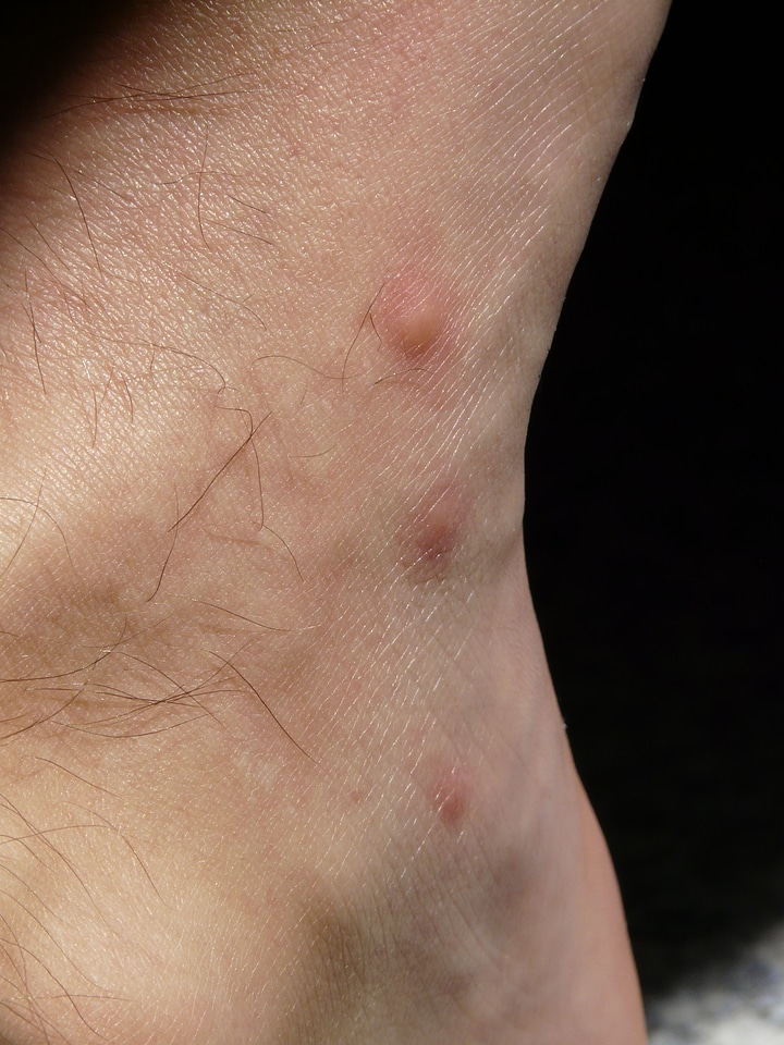 Injection site allergic reaction warty