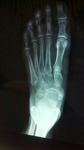 X ray foot bone photo