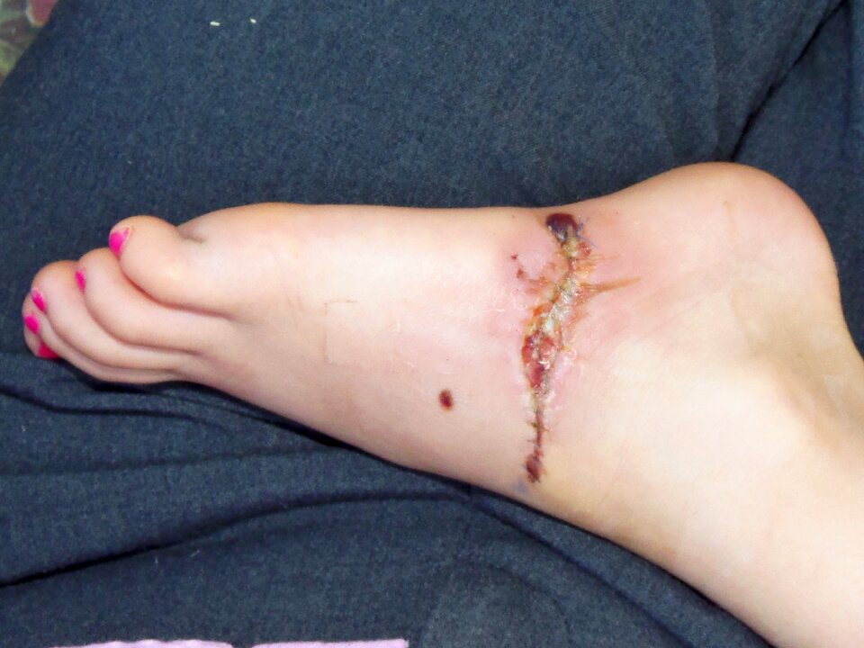 Stitches foot medical