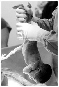 Recent born pregnancy