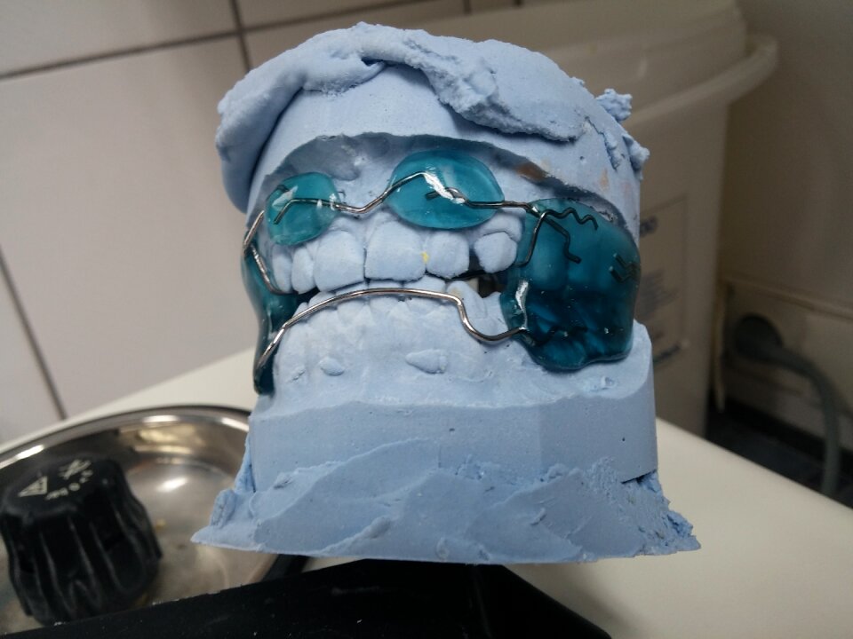 Rails dental braces tooth