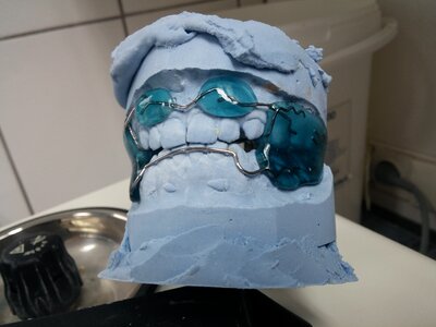 Rails dental braces tooth
