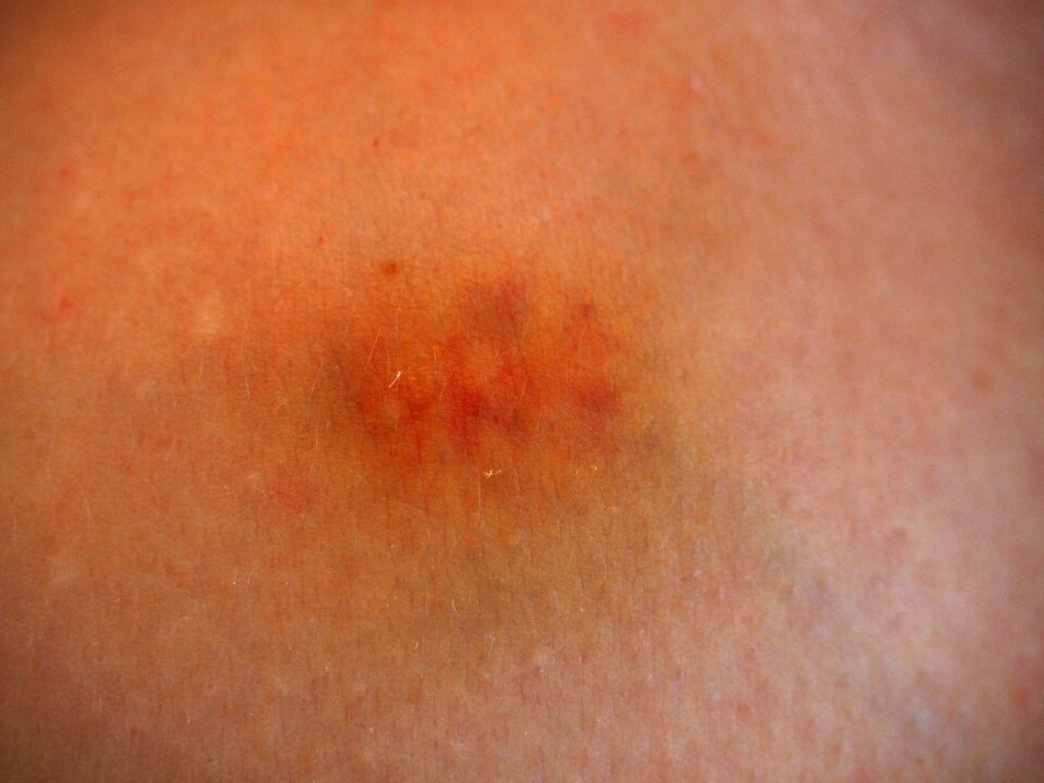 Skin haematoma hematoma - Free photos on creazilla.com