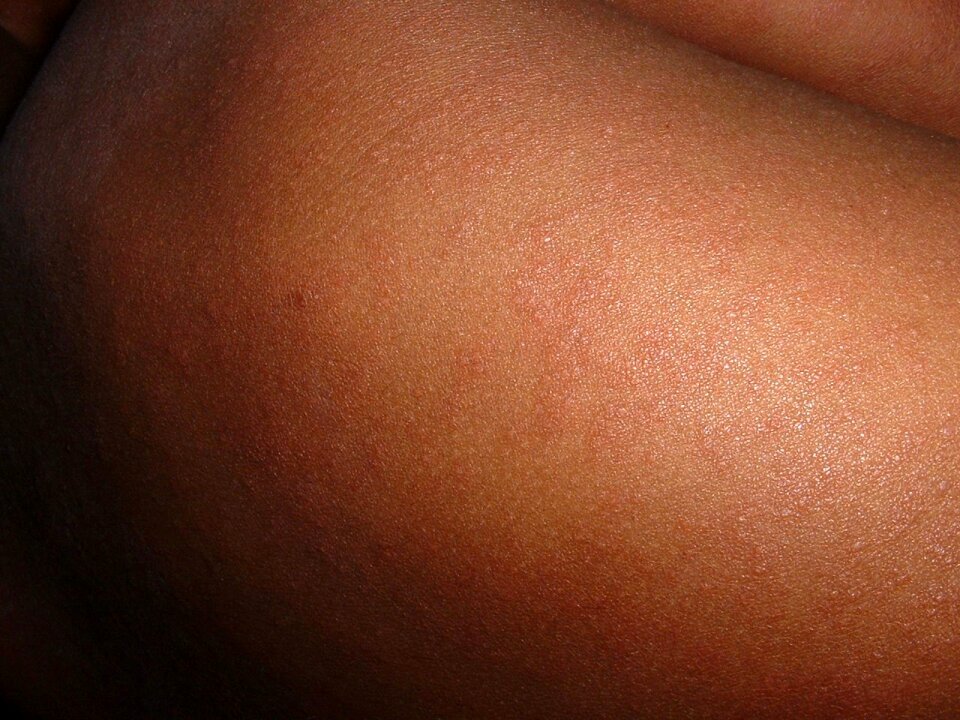 Infectious disease children exanthema