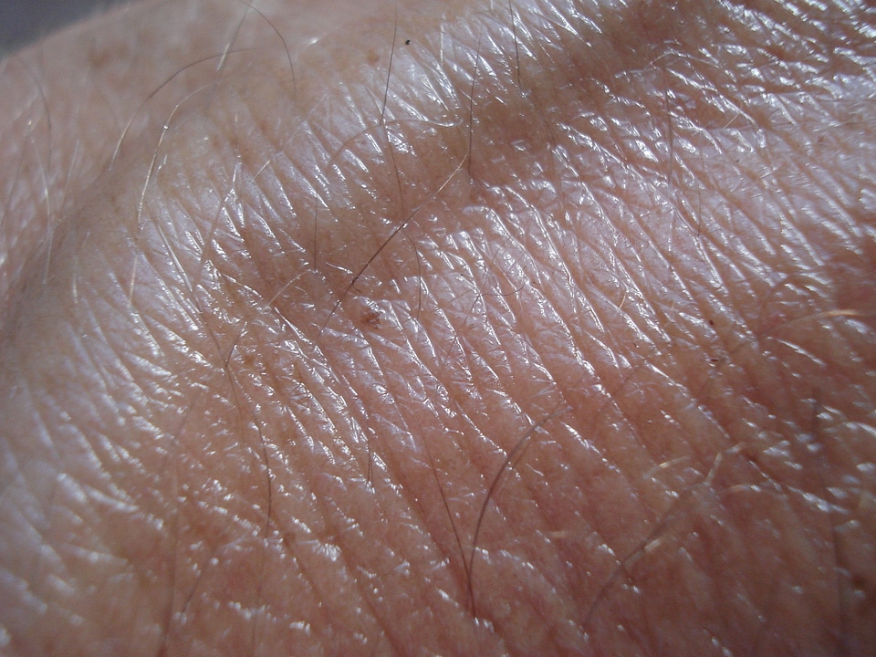 Brown skin cancer human