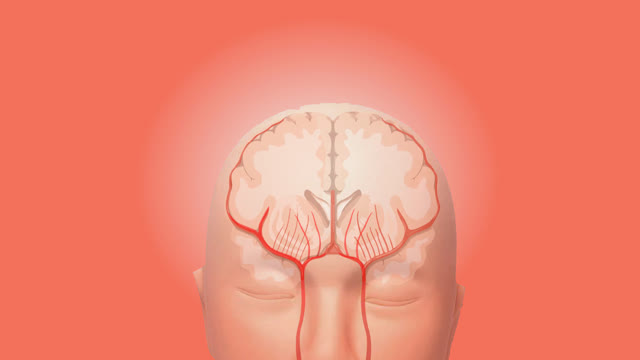 Hemorrhagic brain stroke
