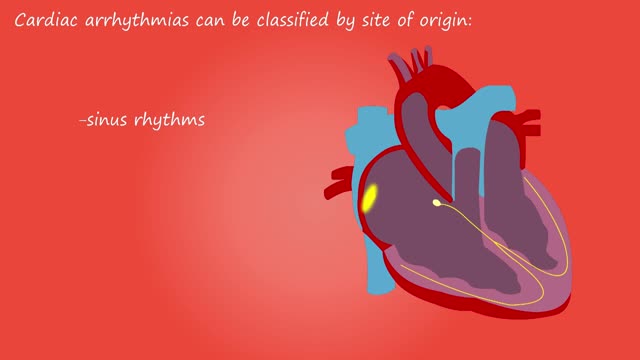 Cardiac arrhythmia heart