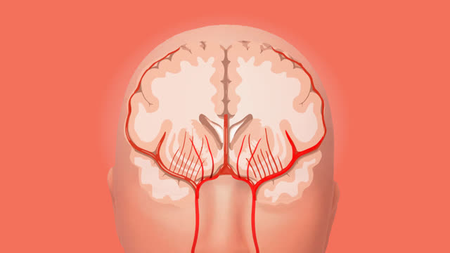 Brain ischemic stroke