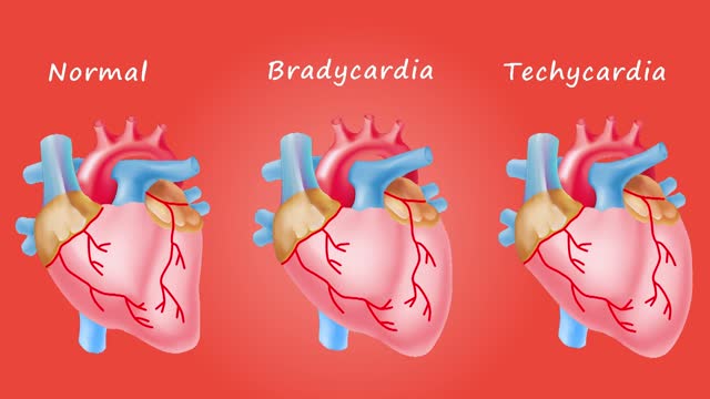Bradycardia tachycardia medical
