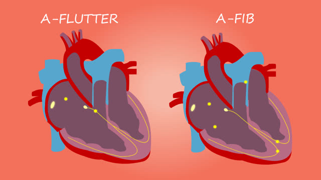Heart atrial fibrillation